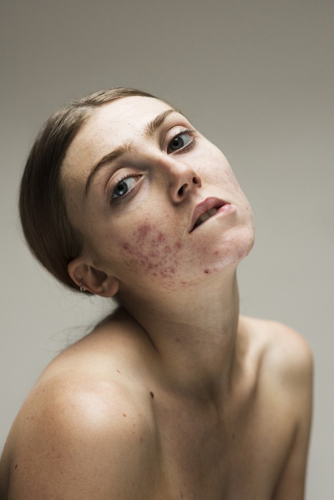 An image from Sophie's series, featuring a model confidently displaying her acne.