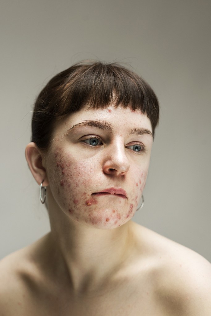 An image from Sophie's series, featuring a model confidently displaying her acne.